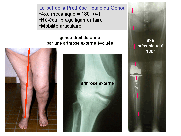 Arthrose du genou à Lyon - Chirurgie orthopédique - Prothèse